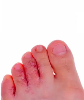 Skin Cancer